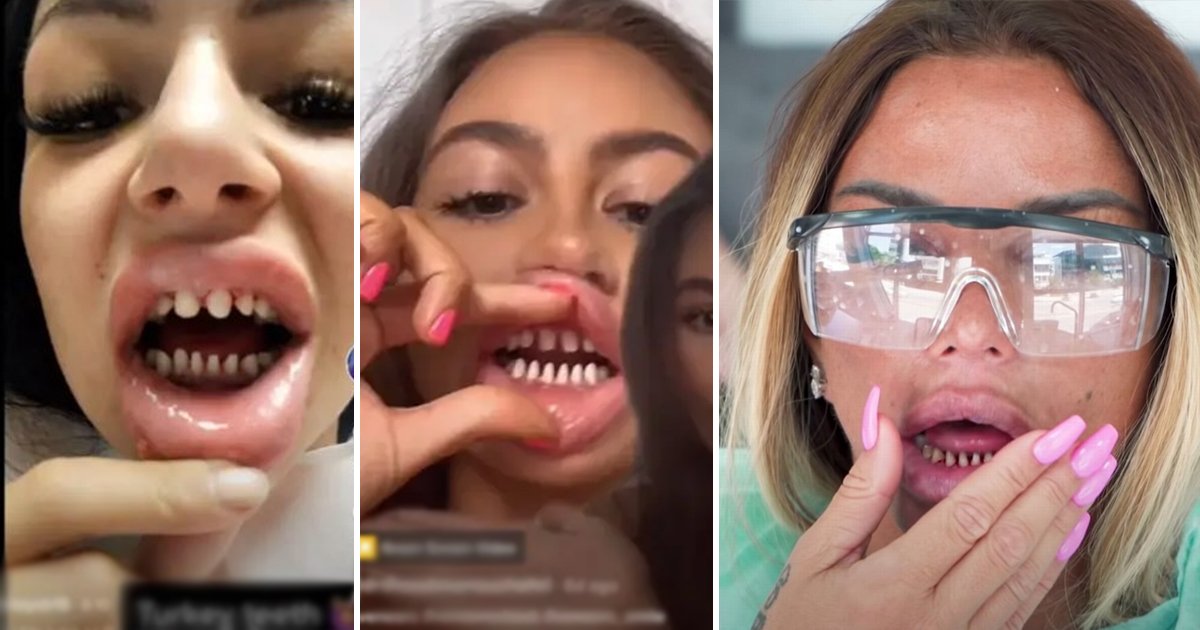 rtrt.jpg?resize=1200,630 - Dentist Warns Teeth-Shaving Teens They'll Need Dentures By Their 40s