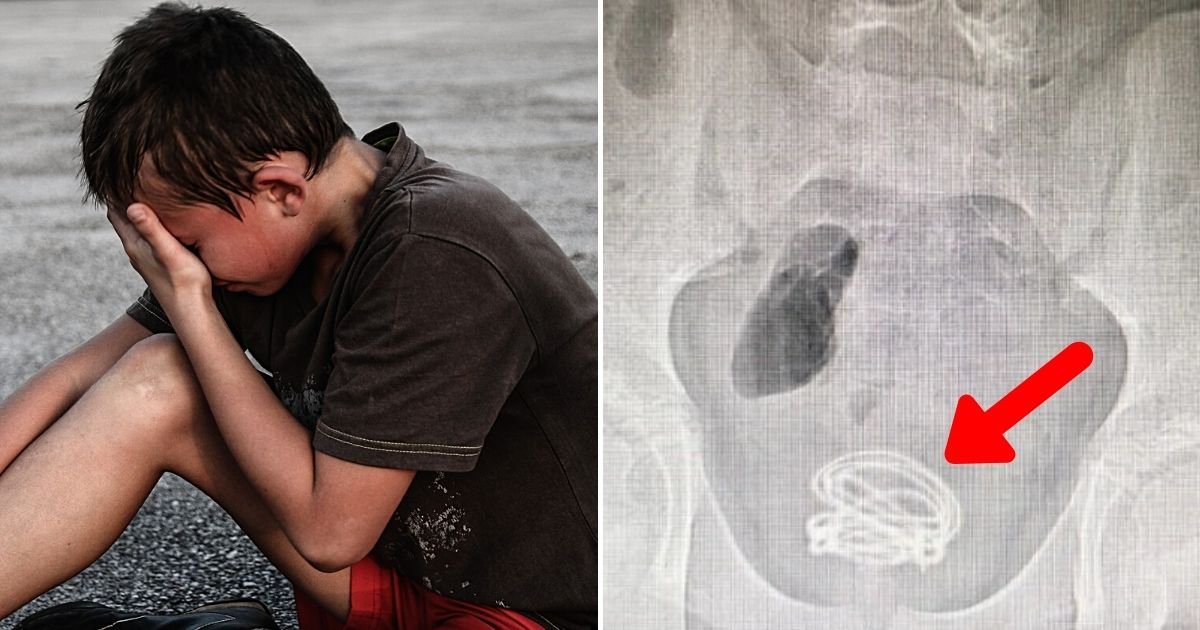 wire5.jpg?resize=412,232 - 13-Year-Old Boy Has 2Ft Electrical Cable Stuck In His Bladder For Three Months