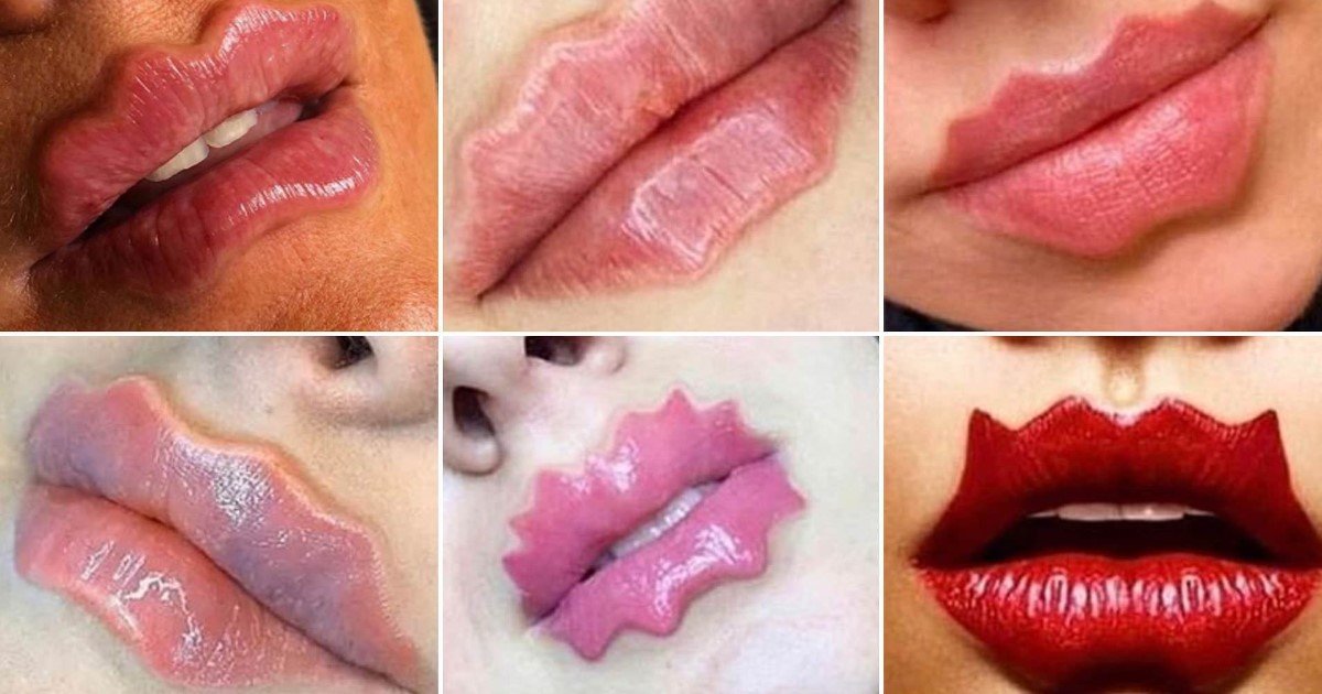 1 126.jpg?resize=412,275 - Mujeres Están Inyectando Relleno Para Crear Ondas Extrañas En Sus Labios Por Una "Nueva Tendencia De Belleza"