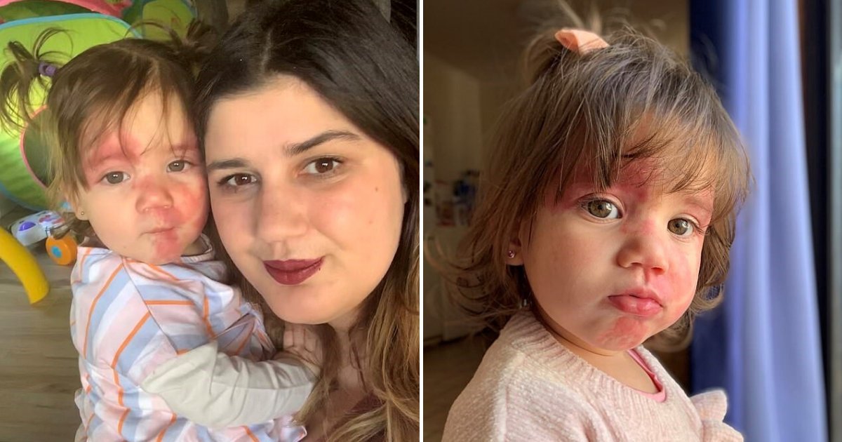 1 4.jpeg?resize=412,232 - Madre Revela Que La Gente Llama 'Horrible' A Su Niña Por Las Marcas Faciales Que Tiene