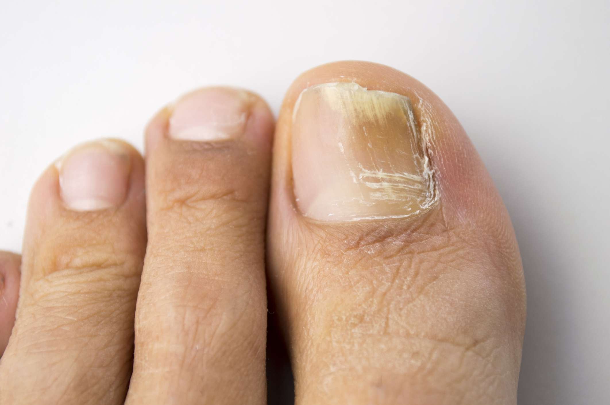 Alarming Reasons Why You Shouldn't Ignore Toenails Falling Off