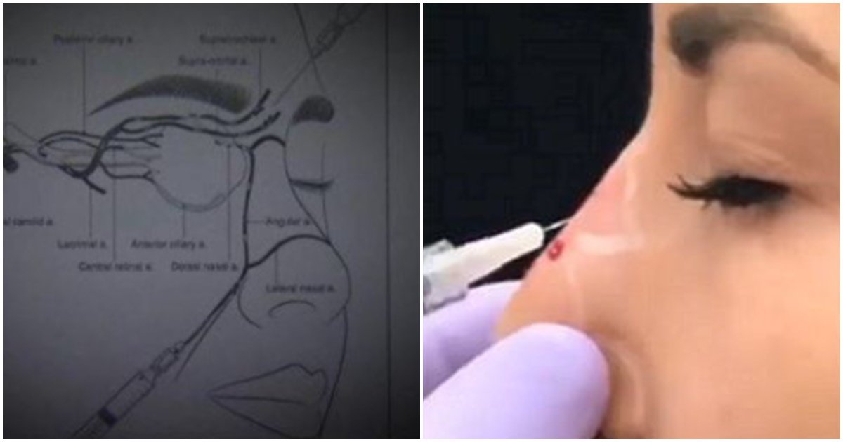 page 98.jpg?resize=1200,630 - "차라리 수술을 하는게.." 코 필러 절대로 함부로 맞으면 안되는 이유 (+시술 영상)