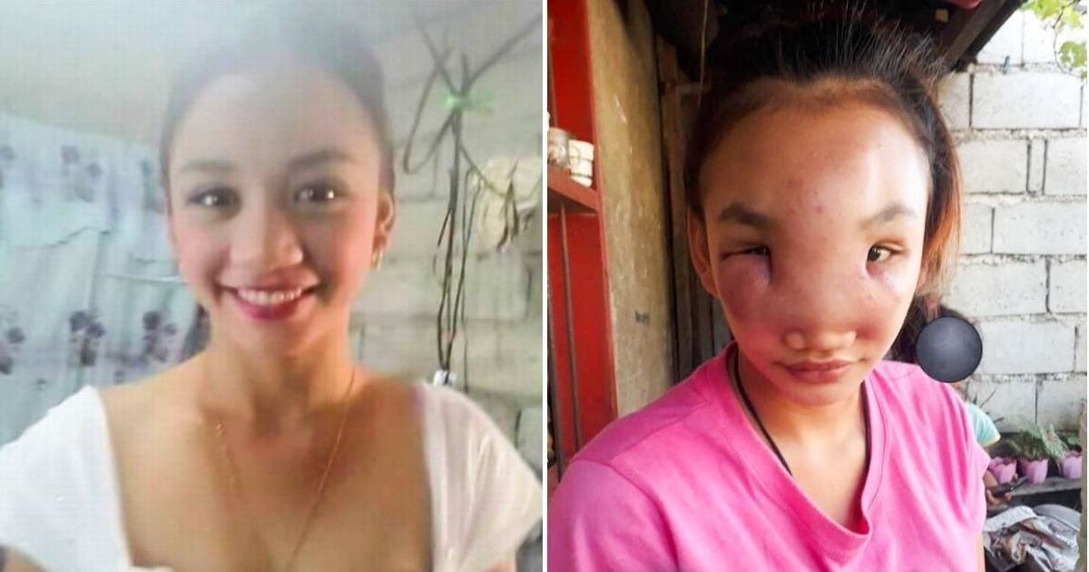 pimple5.jpg?resize=412,275 - 17-Year-Old Girl Nearly Blinded By Mystery Illness After Squeezing A Pimple On Her Nose