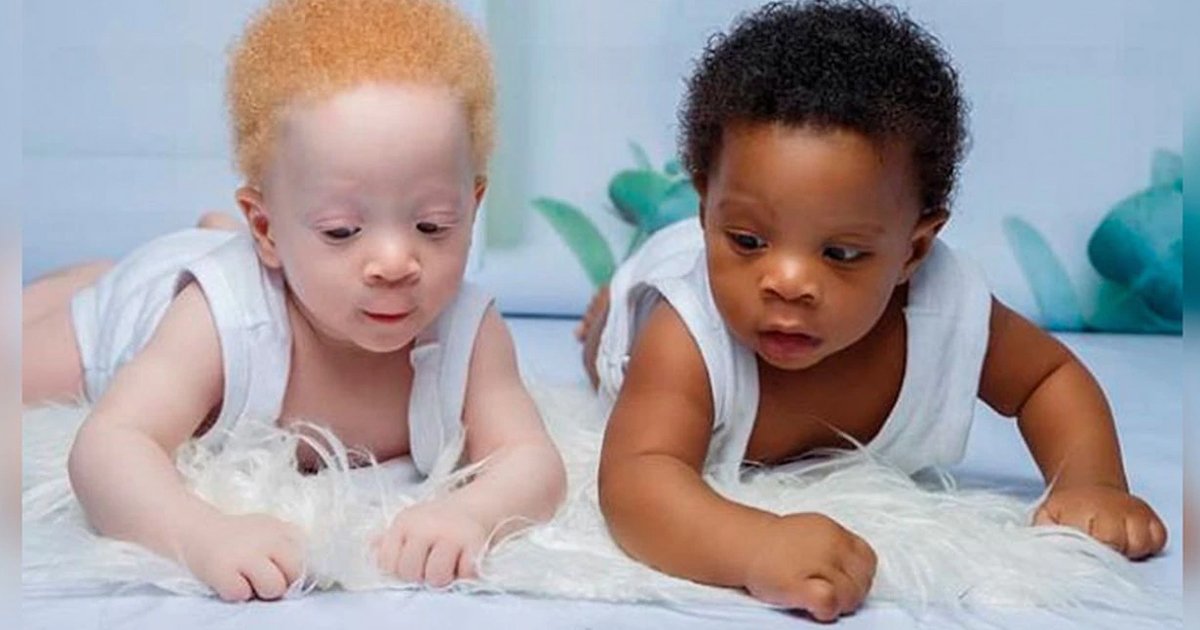 1 104.jpg?resize=1200,630 - Los Bebés Mellizos Con Diferente Color De Piel Que Sorprenden Al Mundo Entero