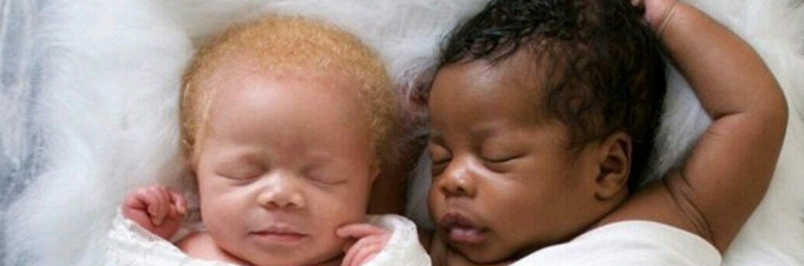 No podía creer que fuese mía”: una mujer dio a luz a gemelos, una albina y  otro negro - Radio Mitre