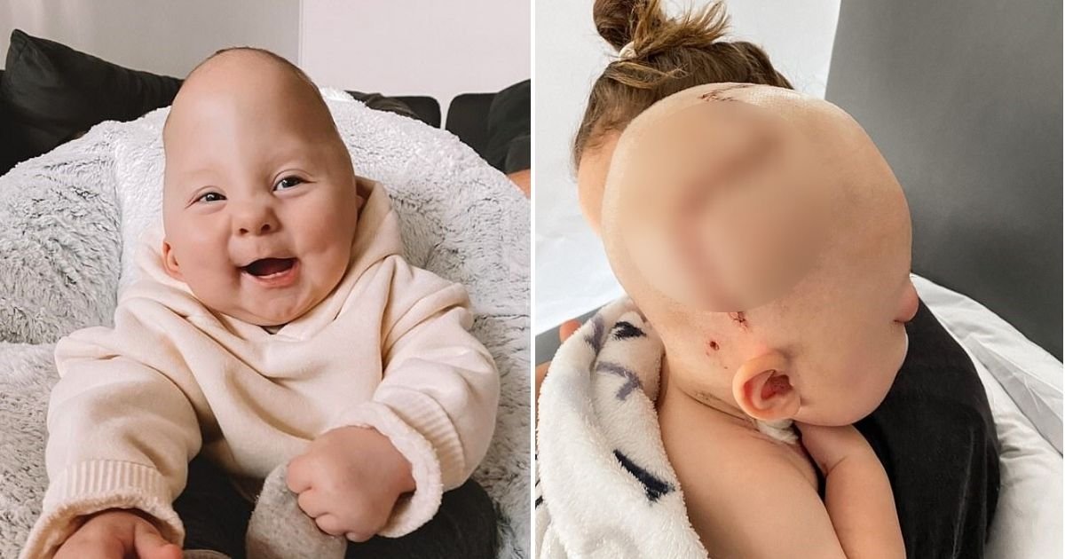 flex6.jpg?resize=1200,630 - Baby Boy Who Born With Craniosynostosis Will Celebrate His First Birthday After A Miracle Surgery