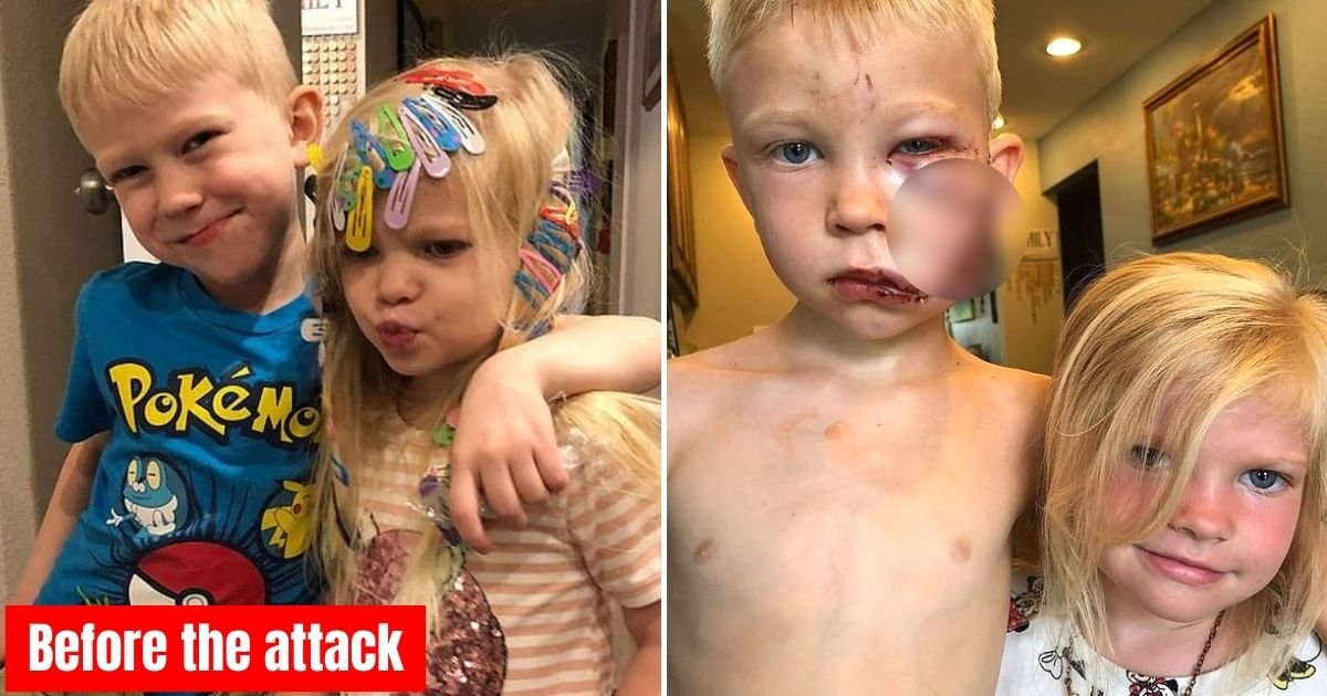 hero8.jpg?resize=412,275 - 6-Year-Old Boy Who Was Mauled By A Dog While Saving His Sister Reveals His Incredible Transformation