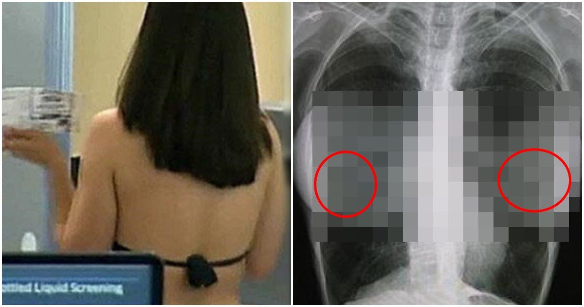 page 354.jpg?resize=1200,630 - 검사를 위해 X-ray를 찍었는데 여성의 '꼭X'에서 발견된 것 때문에 민망해진 의사