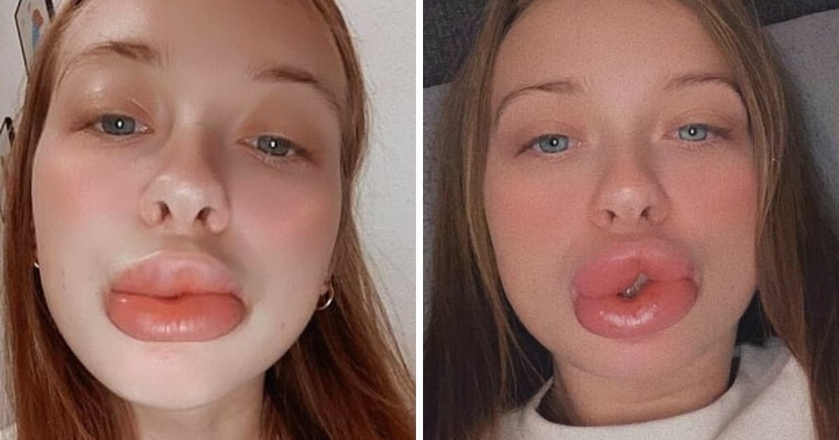 untitled design 23.jpg?resize=1200,630 - Mother Left With 'Massive' Lips 3x The Normal Size After Getting Cheap Filler Treatment