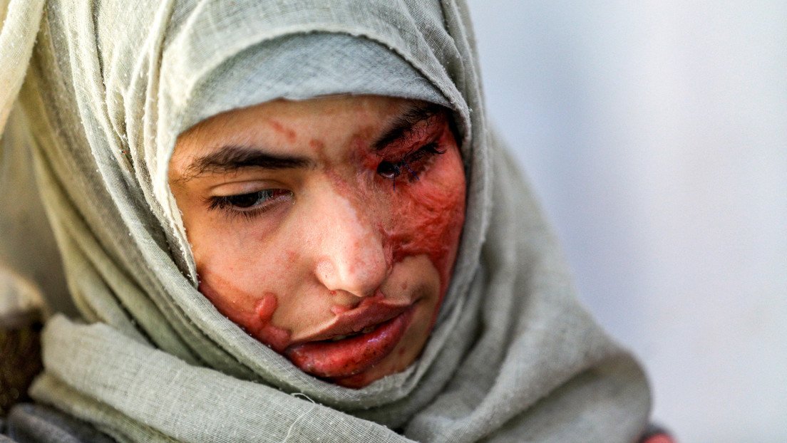 Resultado de imagen de joven yemení es obligada a casarse a los 12 años rostro acido