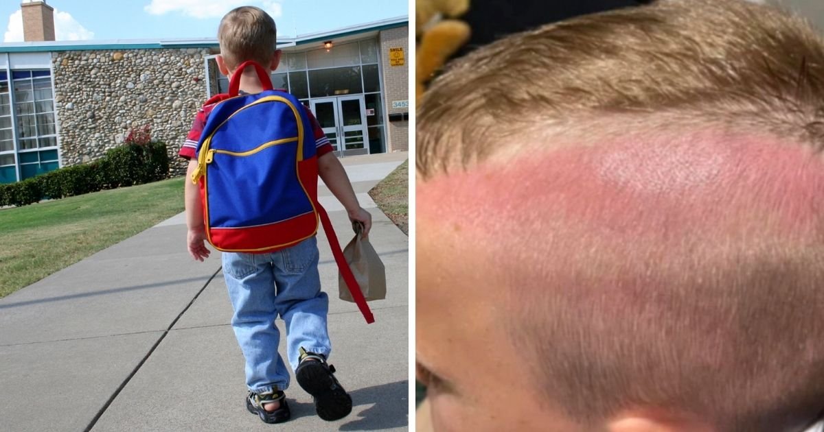 6 29.jpg?resize=412,232 - Mom Sparked Heated Debate About Child’s Safety At School After His Boy Came Home With Sunburnt Head