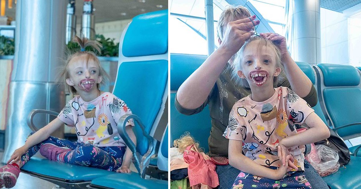 adfasdf.jpg?fit=1024%2C538&ssl=1&strip=all - Pioneering Surgery Allows Young Girl Born With Half A Face To Finally Smile