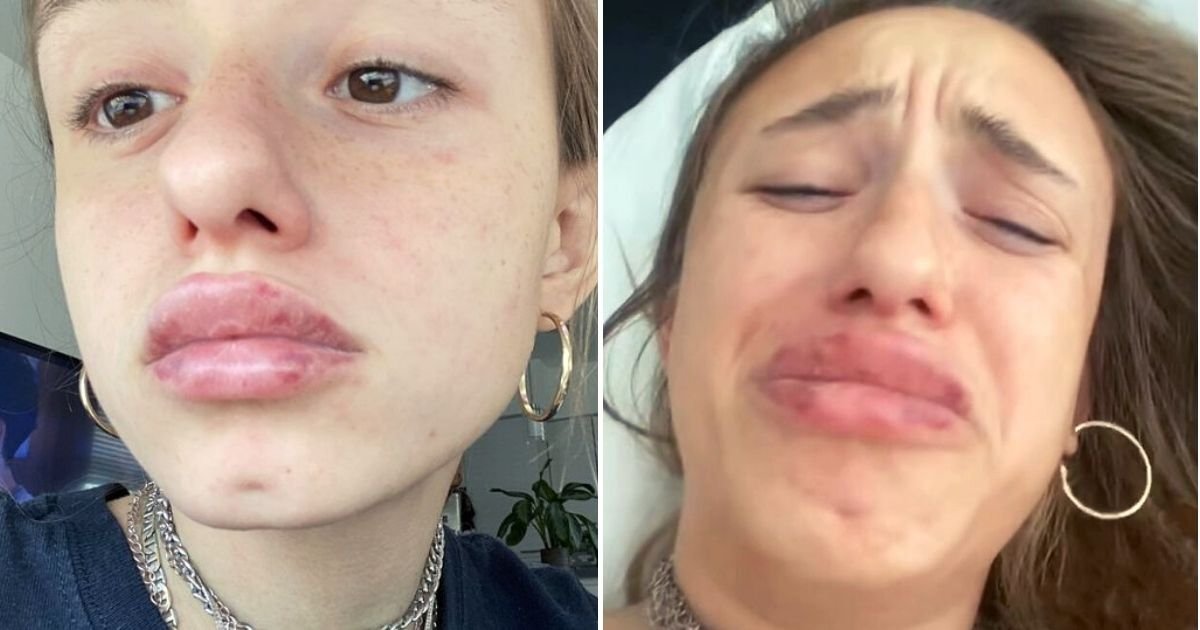 desi6.jpg?resize=1200,630 - Woman Left ‘Looking Like A Character From Monsters Inc’ After Her Lips Ballooned Because Of Cheap Lip Fillers