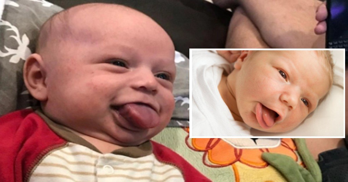 fgsdgsg 1 17.jpg?resize=412,232 - Boy Who Was Born With Tongue Four Times Too Big For Him Needs Another Surgery