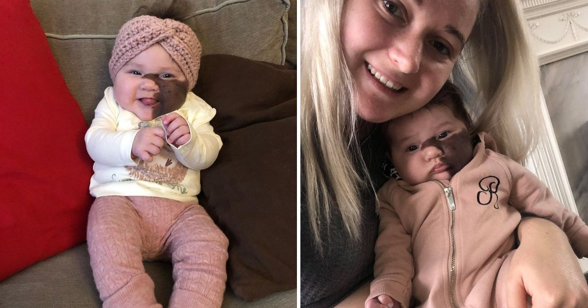 gsgsgssssssssssss.jpg?resize=412,275 - Mum Refuses Surgery For Baby Girl With Giant Birthmark Across Face