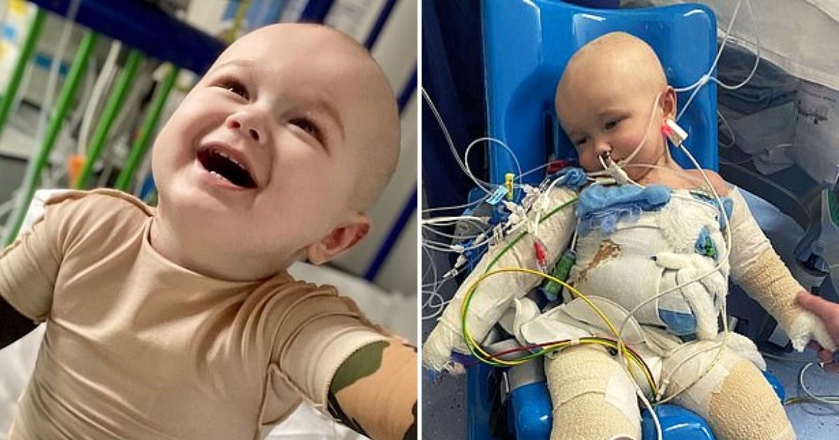 jenson6.jpg?resize=412,232 - Toddler's Skin 'Slipped Off' After He Climbed Into A Scalding Hot Bath