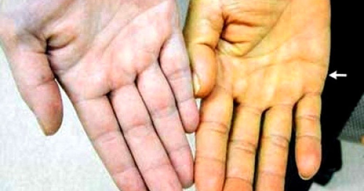 liver hands.jpg?resize=412,275 - 8 Alarming Signs And Symptoms Of Liver Disease That Shouldn't Be Ignored