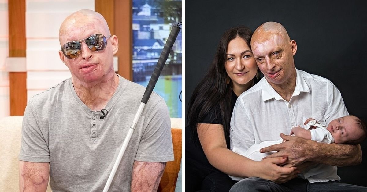 untitled design 10 3.jpg?resize=412,275 - Acid Attack Survivor Is Suffering From Nightmares After Jealous Ex-Girlfriend Poured Acid All Over His Body