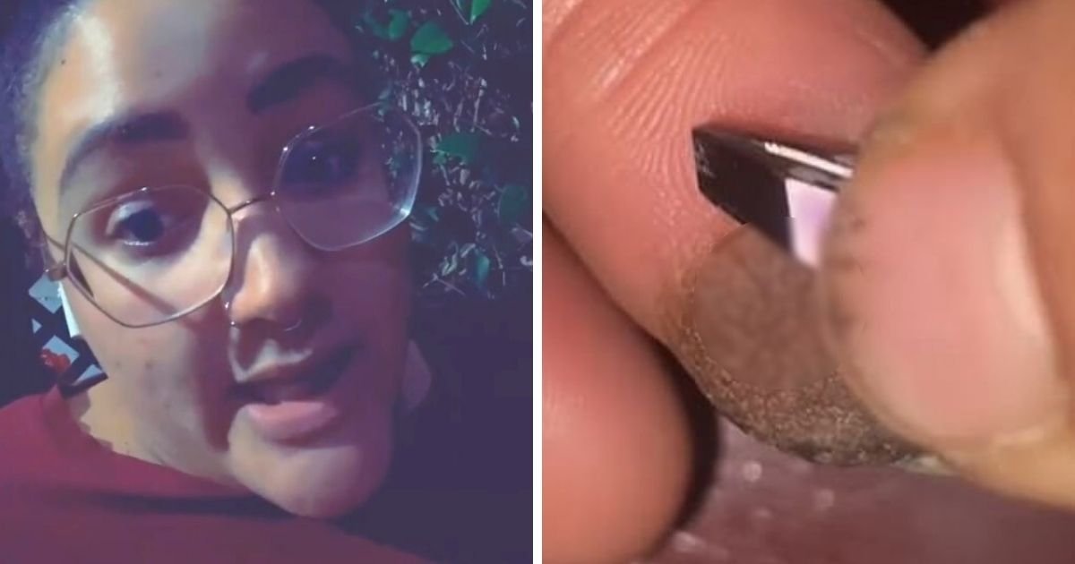 untitled design 3 2.jpg?resize=412,232 - Woman’s Finger Is Growing Pubic Hair Following A Skin Graft