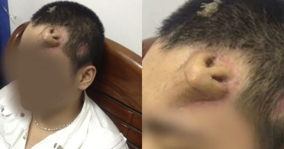 1 136.jpg?resize=412,275 - Surgeons Put Nose On Man’s Forehead After The Original Was Damaged In Car Crash