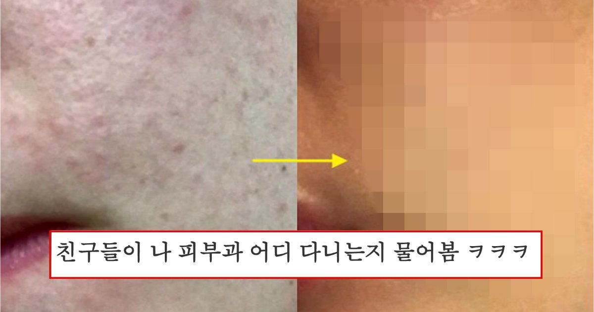 collage 84.png?resize=412,275 - 비듬 샴푸가 여드름에 좋다는 소리를 듣고 직접 해본 여성들이 올린 전후 사진