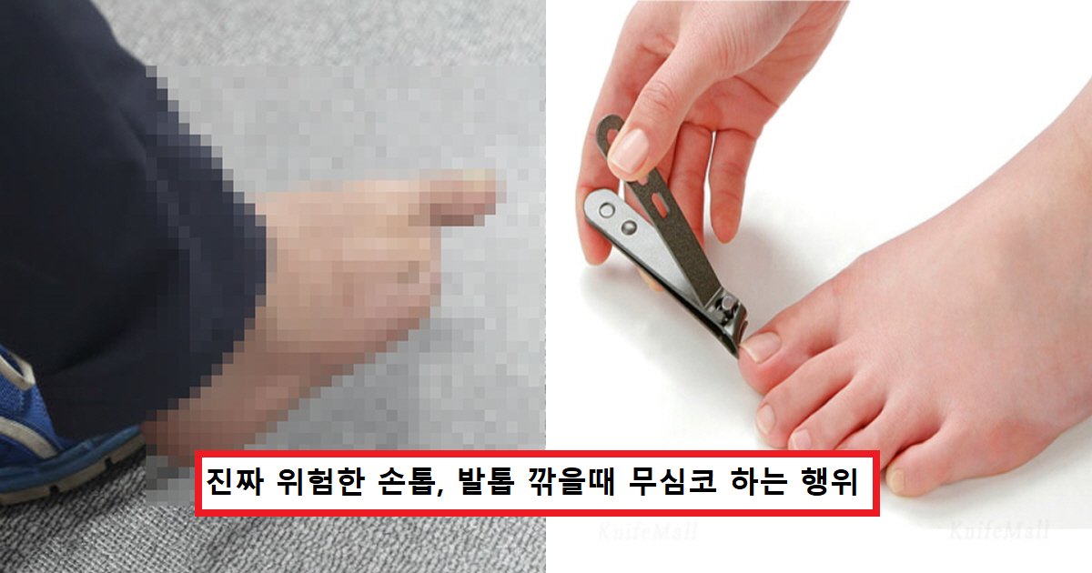 fdsfdsfsdfsd.png?resize=412,275 - "굳은살 제거하다가 발가락 3개 잘랐습니다"..손톱깎이 사용하다 발가락 절단한 남성의 '충격사진'