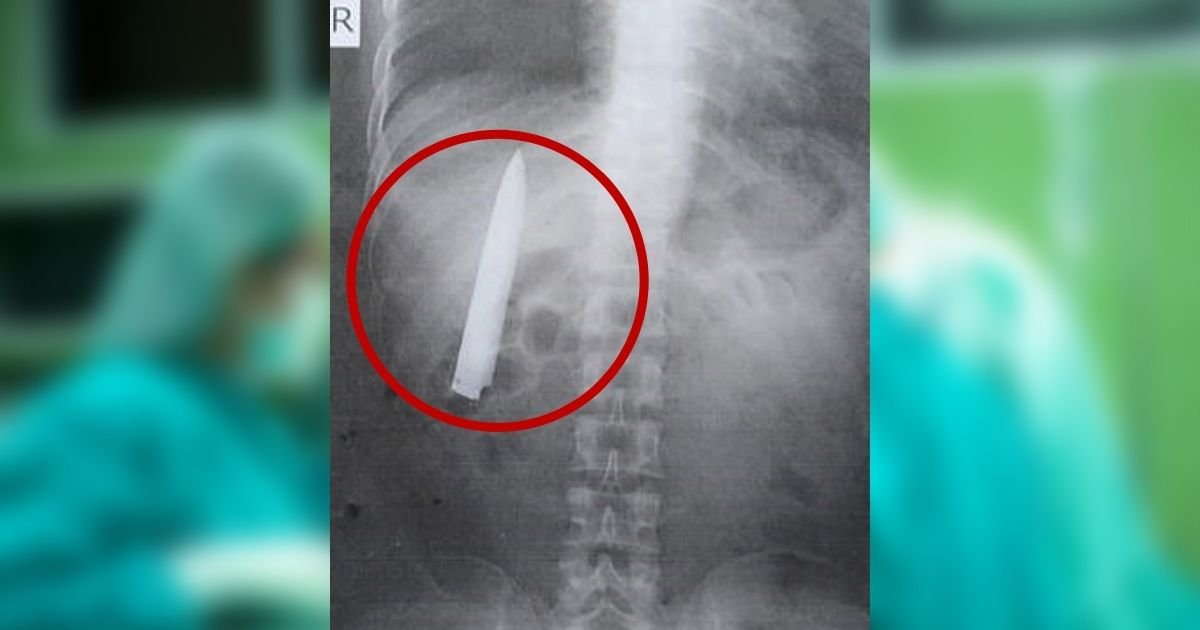 knife.jpg?resize=1200,630 - Man Discovers He Has A KNIFE Inside His Torso 15 MONTHS After Getting Attacked