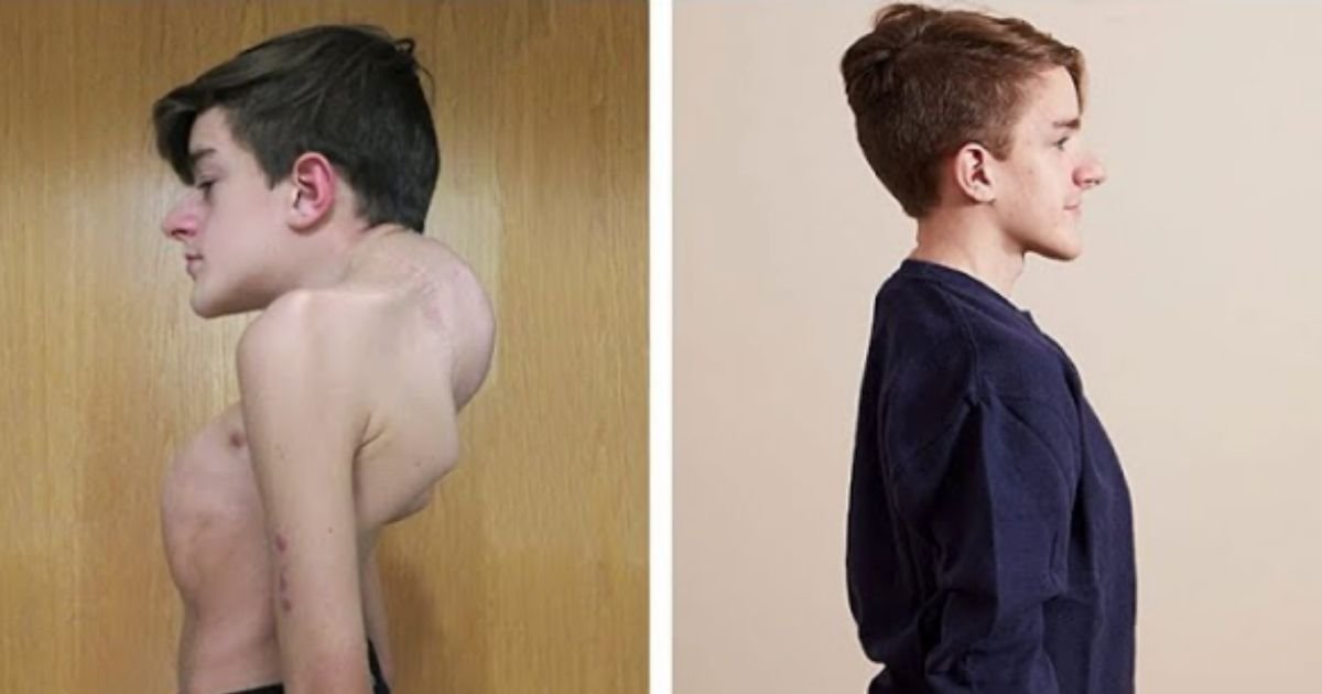 smalljoys 4.jpg?resize=1200,630 - Teen's Body Is Bending By Hour—Until His 18th Surgery Finally Made A Difference