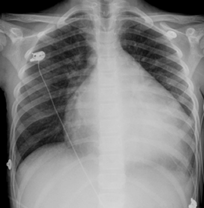 흉부 X-레이 - 심장 및 혈관 장애 - MSD 매뉴얼 - 일반인용