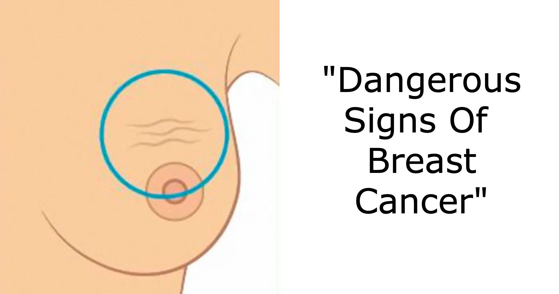 breast cane.jpg?resize=412,232 - 9 Common Warning Signs Of Breast Cancer That People Often Ignore