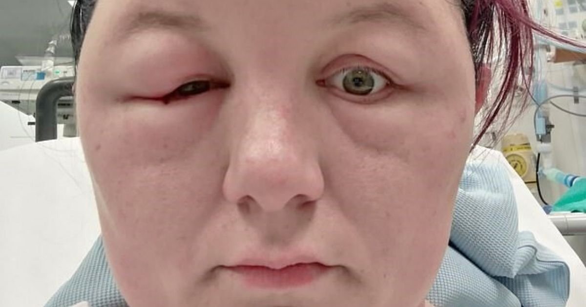 hair6.jpg?resize=412,232 - Mother Rushed To Hospital After Hair Dye Left Her With Blistered Scalp And Swollen Eyes
