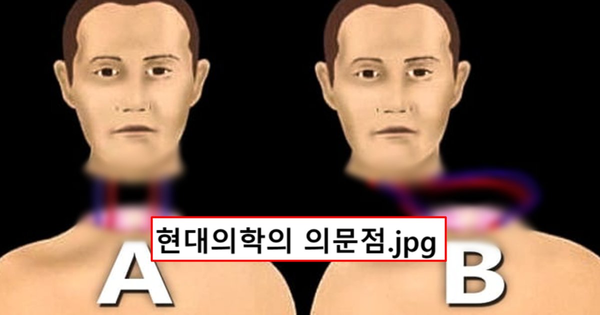 untitled 20 795x436 1.png?fit=1024%2C538&ssl=1&strip=all - 머리를 통째로 이식하는 수술까지도 성공한 현대 의학이 손도 못대고 있는 영역