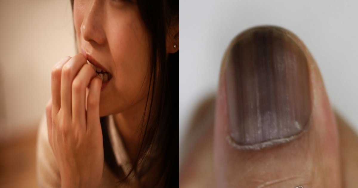 finger.png?resize=1200,630 - 習慣的に爪を噛んで親指を「切断」することになった20代女性の衝撃的な話
