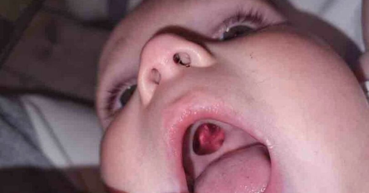 hole5.jpg?resize=1200,630 - Baby Rushed To A Hospital With Huge 'Hole' In His Mouth, Mother Red-Faced After Realizing The Innocent Mistake