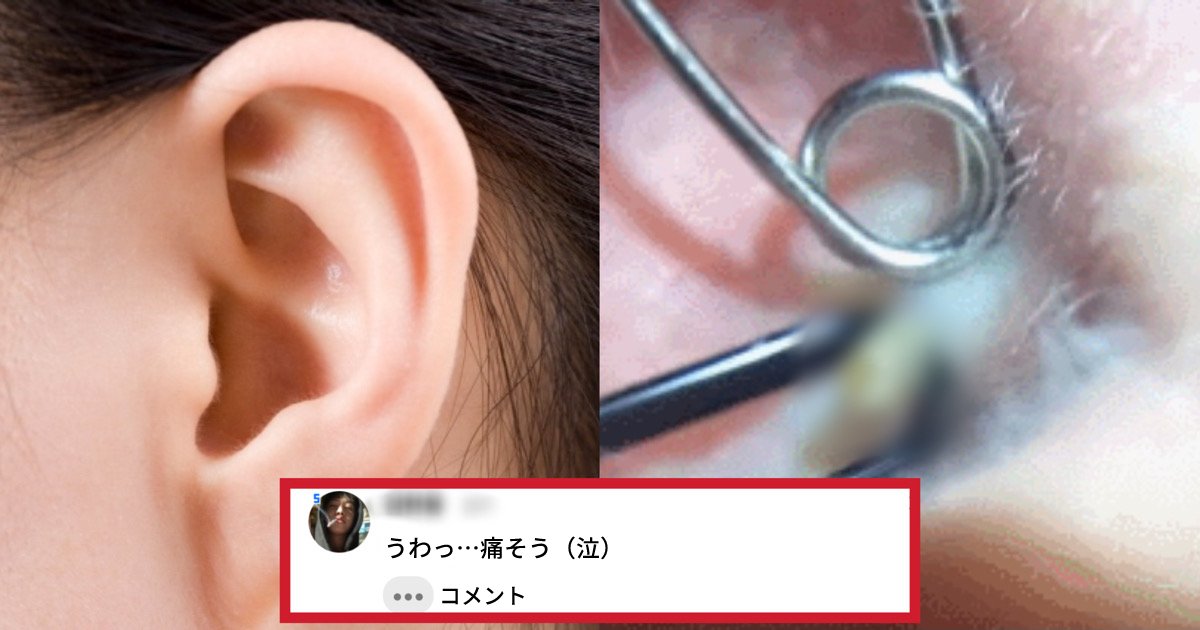 めっちゃ痛そうだけどすごくスッキリする 耳の中のニキビはどうやって除去する 映像あり Hachibachi