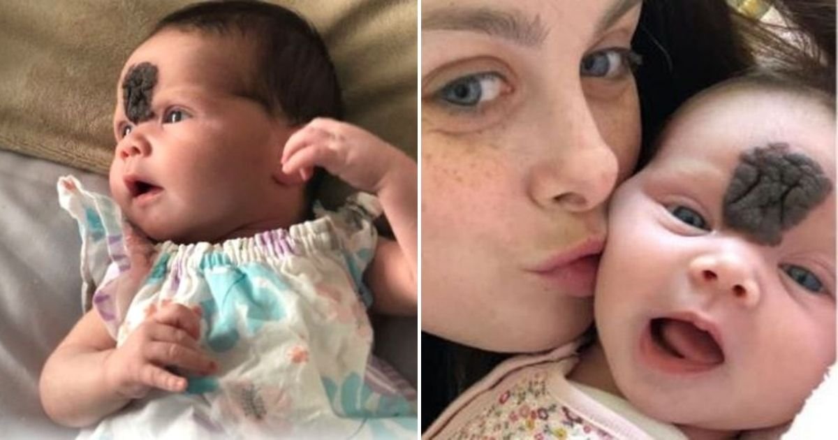 vienna4.jpg?resize=412,232 - Baby Born With A Large Birthmark On Her Face Has Been Denied Treatment, Her Parents Believe It Could Affect Her Mental Wellbeing