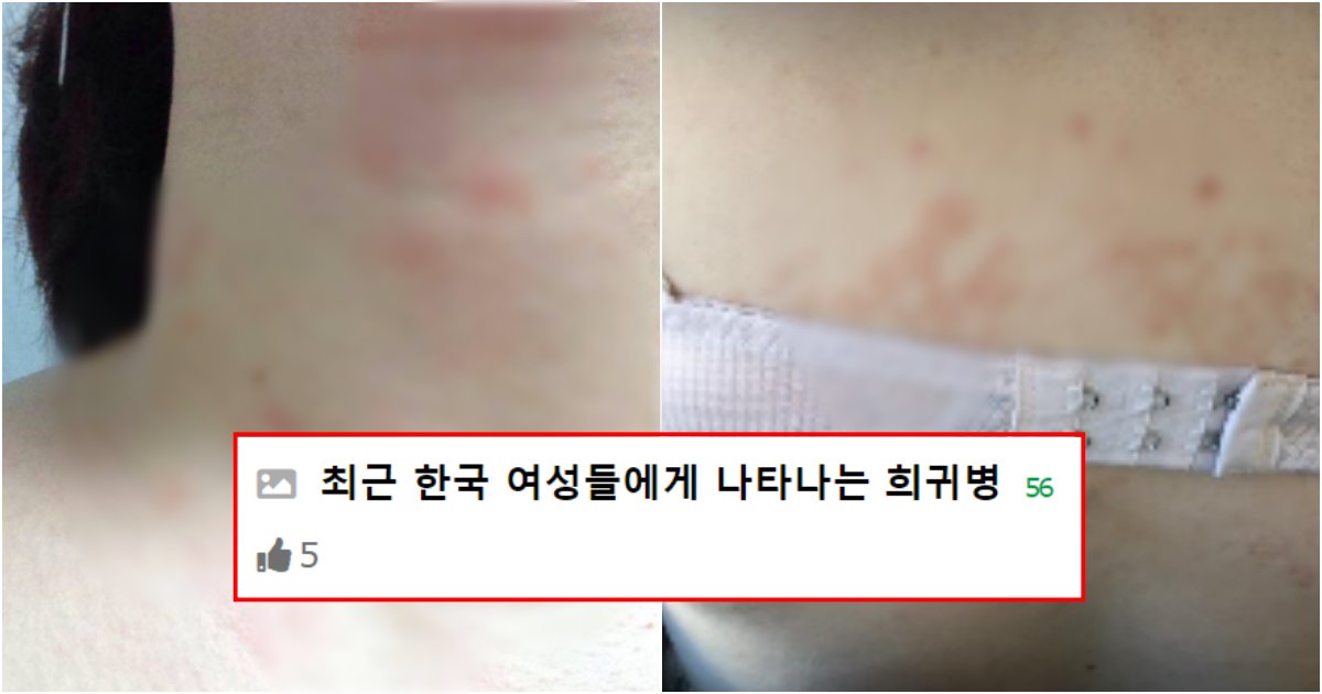 collage 59.png?resize=412,275 - 최근 전세계에서 한국 여성들에게만 나타나는 원인불명의 피부 희귀병 정체
