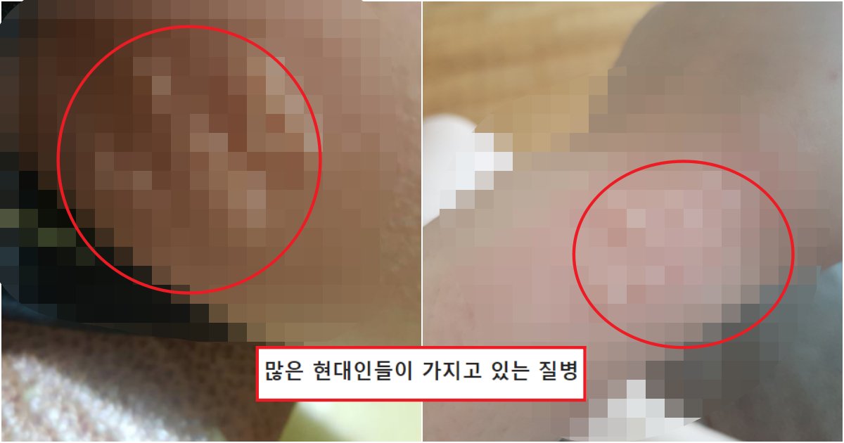 collage 50.png?resize=412,275 - 의외로 대다수가 겪고 있다는 흔한 원인 불명의 질병 (+사진)