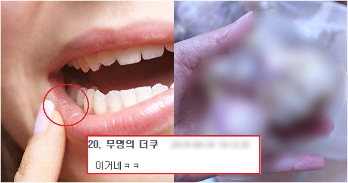 collage 571.png?resize=412,275 - 너무 아프고 신경쓰이는, 입안 염증인 '구내염'의 대처법 3가지