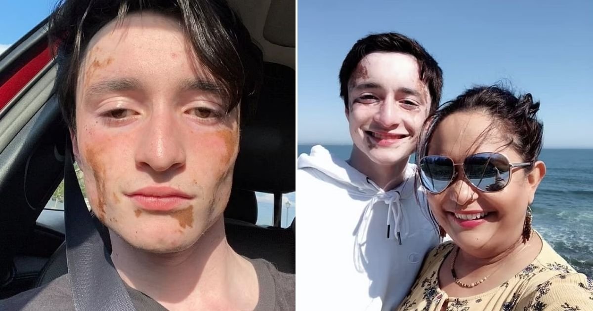 untitled design 11 1.jpg?resize=412,275 - Teenage Boy With Vitiligo Gets Accused Of 'Cultural Appropriation' Because Of His Unique Looks