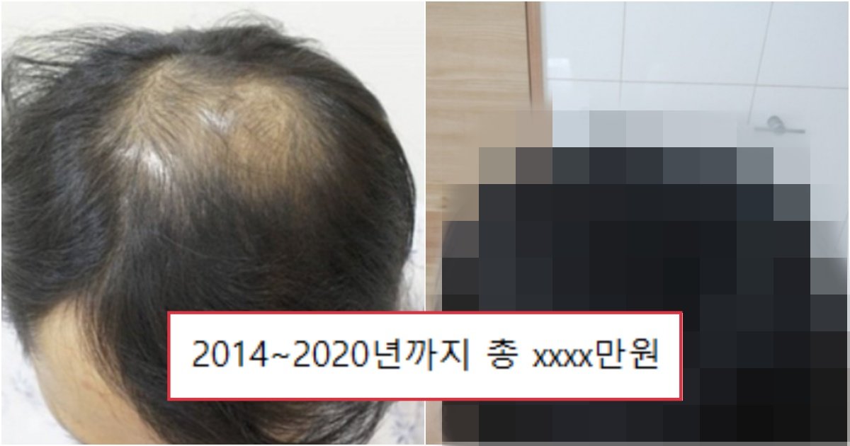 collage 360.jpg?resize=412,275 - 모발이식 고민하는 사람들은, 충분히 진짜 해볼만한 모발이식의 위대함(+비교전후)