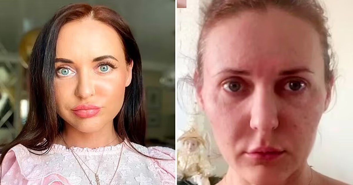 t3 4.jpg?resize=1200,630 - "I Lost My Face Forever"- Woman's Skin 'Shrinks Like A MUMMY' After Beauty Treatment Ages Her 10 Years Overnight