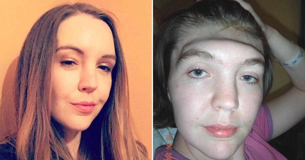 Woman Who Lost Her Entire Forehead Because Of A Common Mistake Is ...