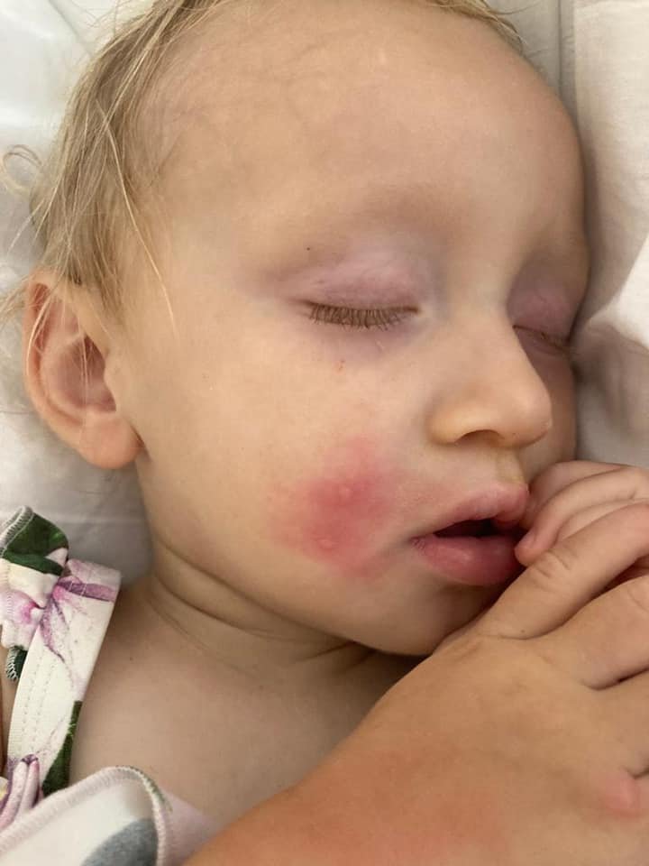 One-year-old Charlotte has been left smothered in painful bites on her hands and face