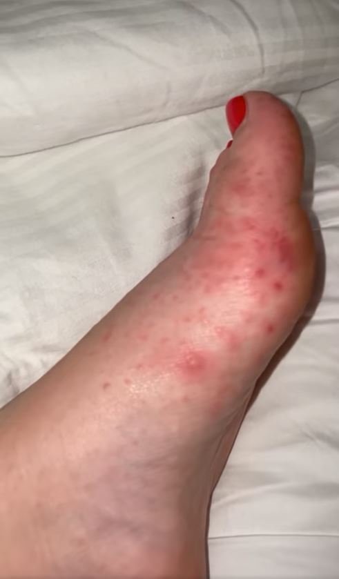 The family have returned home from their trip to Cancun, Mexico covered in nasty bites