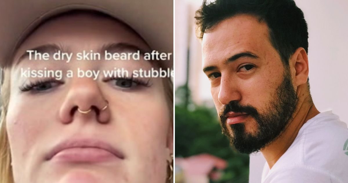 chin3.jpg?resize=412,232 - ‘It Hurts So Bad!’ Woman Left Horrified After She Kissed A Man With A Beard And The Skin On Her Chin Peeled Off