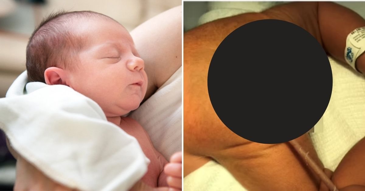 tail.jpg?fit=1024%2C538&ssl=1&strip=all - Baby Boy Born With 12cm TAIL With A Ball On The End, Doctors Confirmed It Has No Elements Of Bone And Cartilage