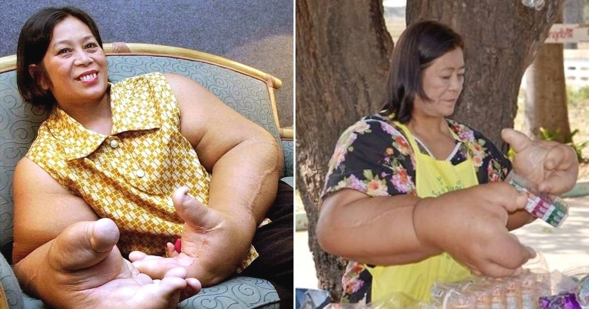 untitled design 85.jpg?fit=1024%2C538&ssl=1&strip=all - Woman With Massive Hands Reveals She Was Forced To Stop Hiding From The World After Her Parents Became Old And Frail