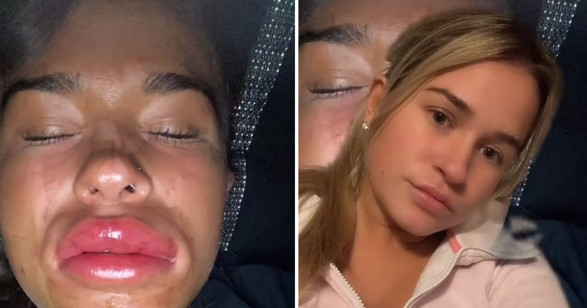 d115.jpg?resize=412,275 - Woman Wakes Up In 'Ridiculous' Pain With Giant Swollen Face After Drinking Alcohol Within Hours Of Undergoing Lip Filler Procedure