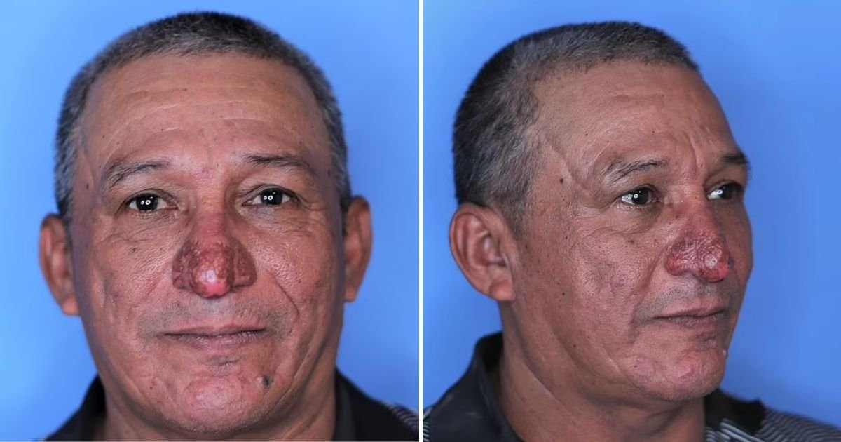 nose5.jpg?resize=1200,630 - Man Who Can't Eat And Breathe Properly Because Of His Deformed NOSE Receives A Life-Changing Surgery For Free